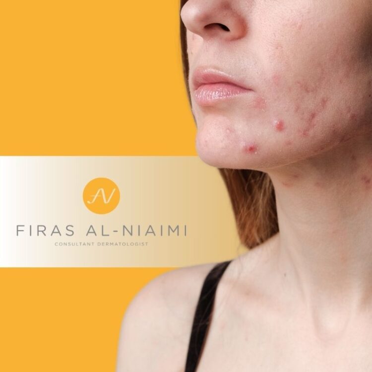 Hormonal Breakouts: How Hormones Affect Your Skin